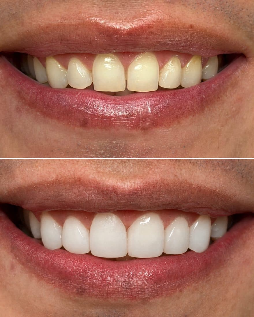 Carillas dentales