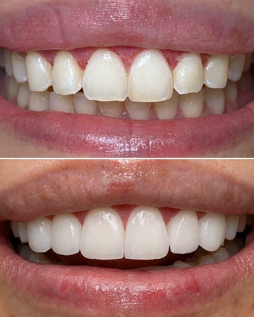 Antes y después · lentes cerámicos