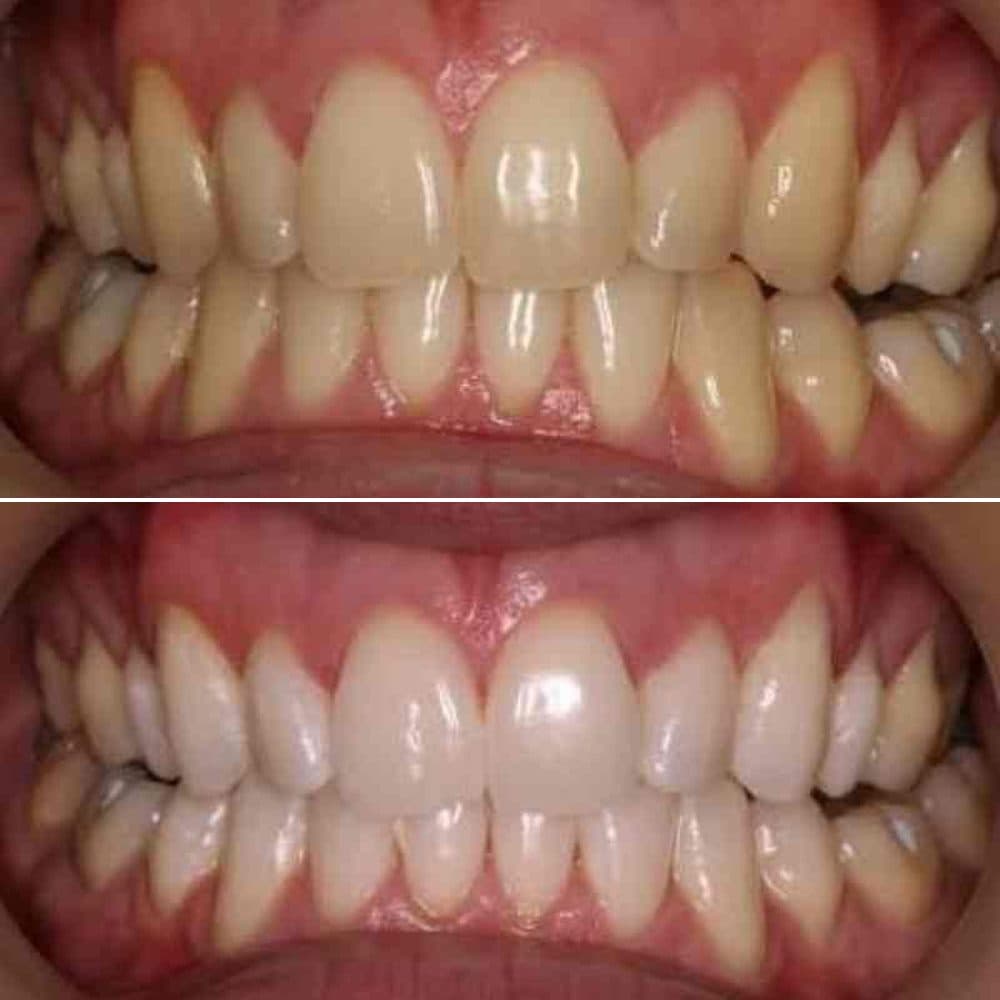 Foto: antes y después · blanqueamiento