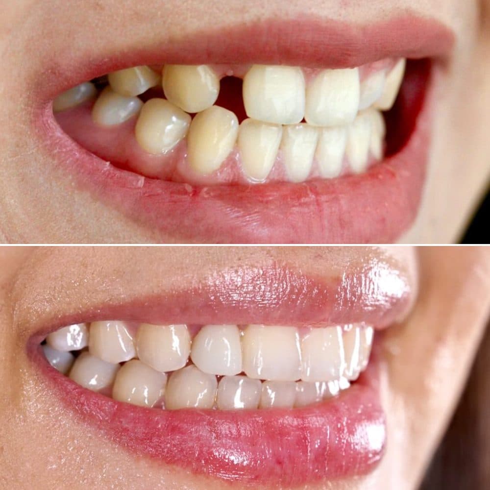 Foto: antes y después · implantes
