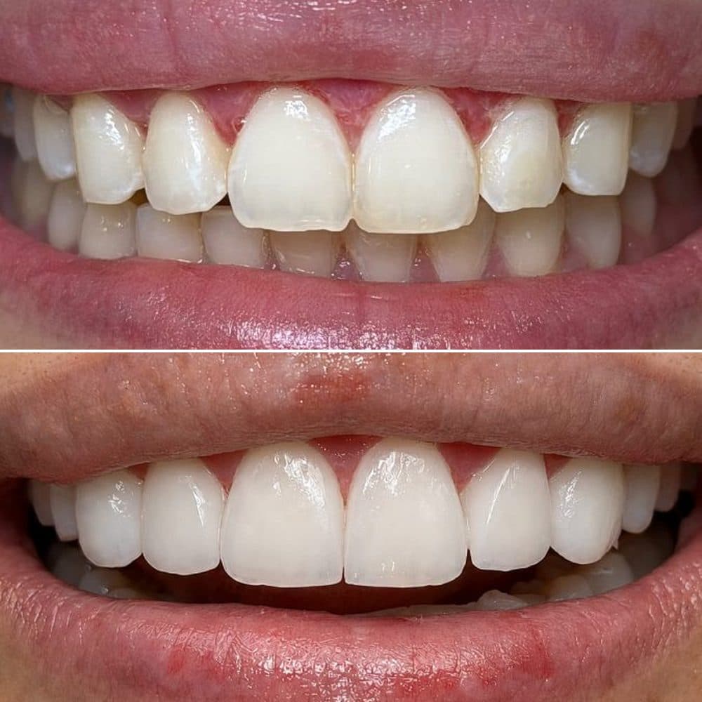 Foto: antes y después · diseño de sonrisa
